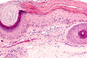 Risque d’événements indésirables cardiovasculaires et de cancer sous tofacitinib