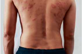 Baricitinib en association avec les dermocorticoïdes dans la dermatite atopique modérée à sévère Baricitinib en association avec les dermocorticoïdes dans la dermatite atopique modérée à sévère