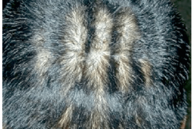 La pachydermie occipitale vorticellée du cuir chevelu (cutis verticis gyrata) La pachydermie occipitale vorticellée du cuir chevelu (cutis verticis gyrata)