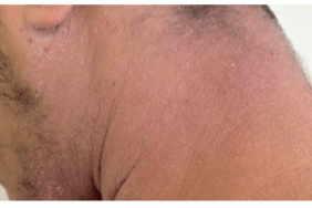 La dermatite atopique : savoir repérer les pièges diagnostiques La dermatite atopique : savoir repérer les pièges diagnostiques