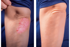 Contrôler le psoriasis : une réalité en 2020 ? Contrôler le psoriasis : une réalité en 2020 ?