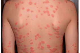 Psoriasis de l’enfant : prendre en compte les particularités liées à l’âge Psoriasis de l’enfant : prendre en compte les particularités liées à l’âge