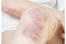 Psoriasis, vers la personnalisation de la prise en charge Psoriasis, vers la personnalisation de la prise en charge
