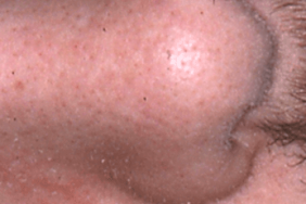 Efficacité du tacrolimus 0,1 % en traitement d’entretien de la dermite séborrhéique Efficacité du tacrolimus 0,1 % en traitement d’entretien de la dermite séborrhéique