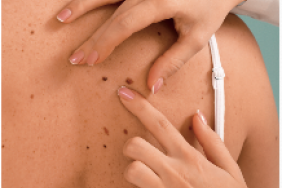 Chirurgie d’exérèse et ganglion sentinelle dans le mélanome primitif Chirurgie d’exérèse et ganglion sentinelle dans le mélanome primitif