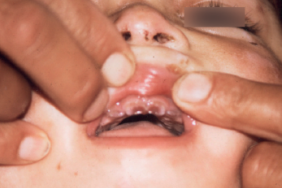 Formes inhabituelles de porphyrie érythropoïétique congénitale spontanément régressive : suivi de cas familiaux sur 28 ans