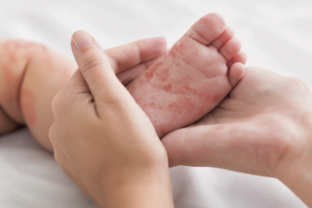 Dermatite atopique : quand faire un bilan allergologique ?