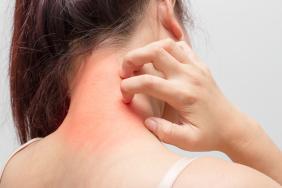 La dermatite atopique à l’heure des inhibiteurs de JAK