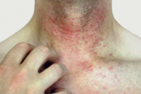 Tralokinumab : un anti-IL-13 dans la dermatite atopique