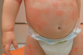 Dermatologie pédiatrique : de nombreuses avancées
