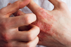Douleurs cutanées dans le psoriasis
