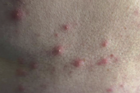 Quel diagnostic évoquer chez cette patiente de 48 ans qui consulte dans le cadre de petites papules érythémateuses, parfois pustuleuses, d’apparition soudaine, au retour de vacances sur la Côte d’Azur ?