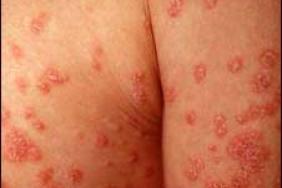 Psoriasis : le bimekizumab agit vite et longtemps Psoriasis : le bimekizumab agit vite et longtemps