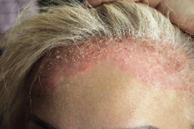 Le psoriasis dans tous ses états