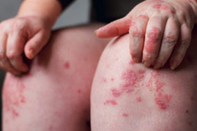 Nouvelles perspectives de prise en charge du psoriasis