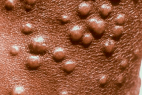 Infections humaines à poxvirus