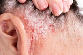 Psoriasis : première démonstration de l’efficacité d’un traitement d’entretien topique à long terme Psoriasis : première démonstration de l’efficacité d’un traitement d’entretien topique à long terme