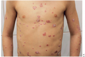 Psoriasis de l’enfant : quelles nouveautés ?