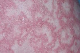 Quelle gestion en pratique du traitement du psoriasis pendant la grossesse ? Quelle gestion en pratique du traitement du psoriasis pendant la grossesse ?