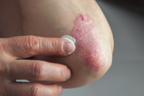 Tolérance des traitements biologiques dans le psoriasis