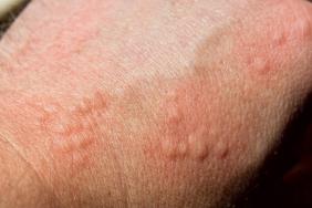 Urticaire chronique spontanée : comment optimiser le parcours de soins des patients Urticaire chronique spontanée : comment optimiser le parcours de soins des patients