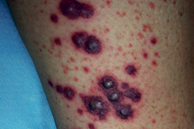 Vascularite cutanée - Classification, diagnostic, bilan d’extension