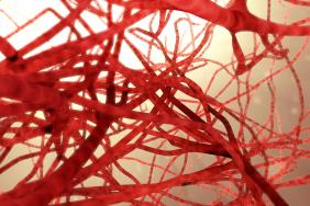 Malformations vasculaires : quand et comment traiter ? Malformations vasculaires : quand et comment traiter ?
