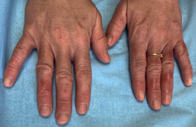 Manifestations dermatologiques de la Covid-19