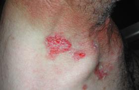 Rituximab versus mycophenolate mofetil dans le pemphigus vulgaire