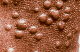 Infections humaines à poxvirus