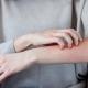 La dermatite atopique à l’ère de l’arrivée des anti-JAK