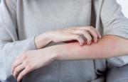 La dermatite atopique à l’ère de l’arrivée des anti-JAK