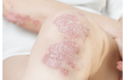 Psoriasis, vers la personnalisation de la prise en charge