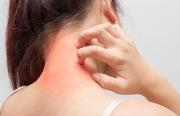 La dermatite atopique à l’heure des inhibiteurs de JAK