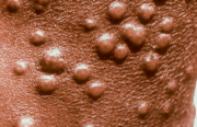 Infections humaines à poxvirus